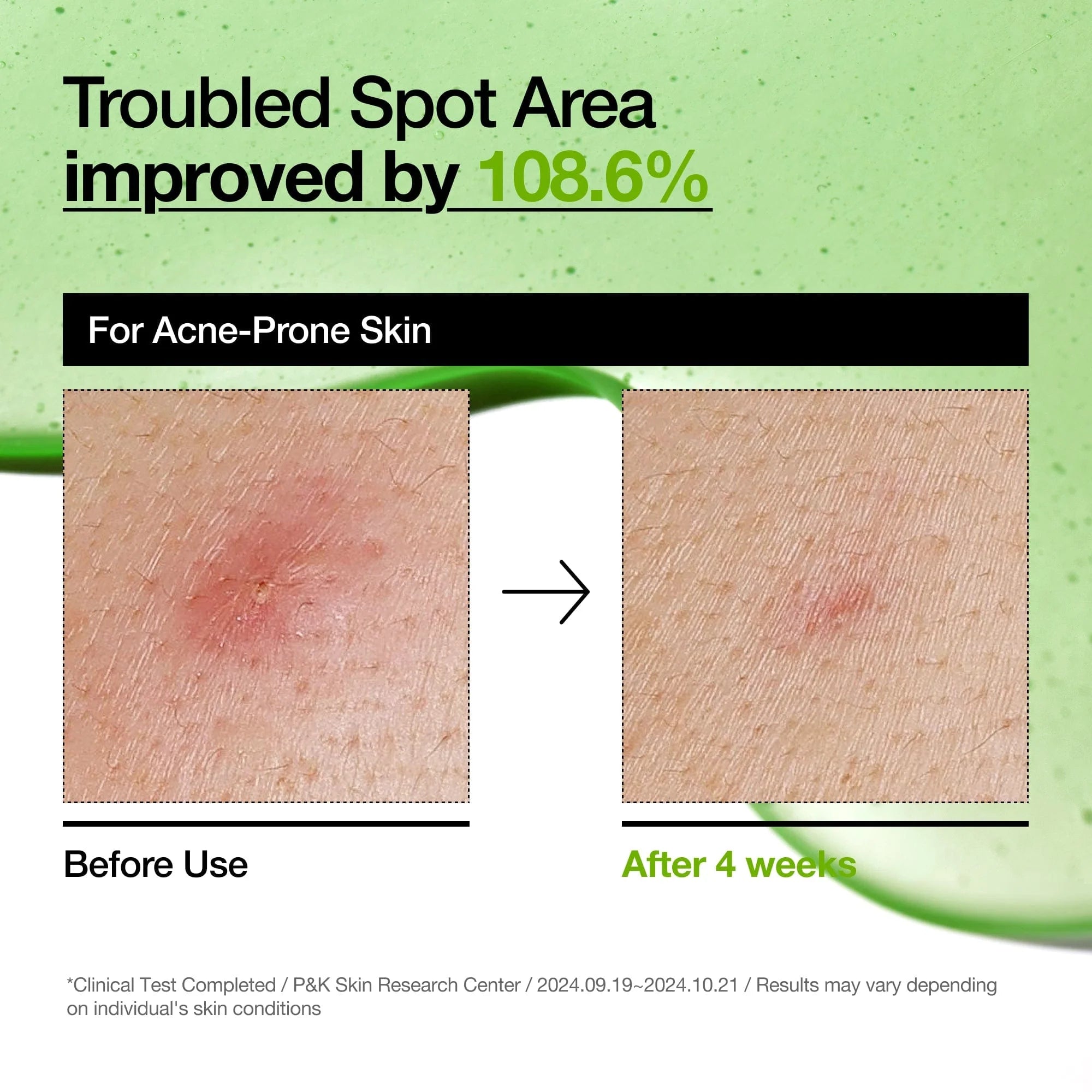 ANUA Azelaic Acid 10 + Hyaluron Redness Soothing Serum (30ml)